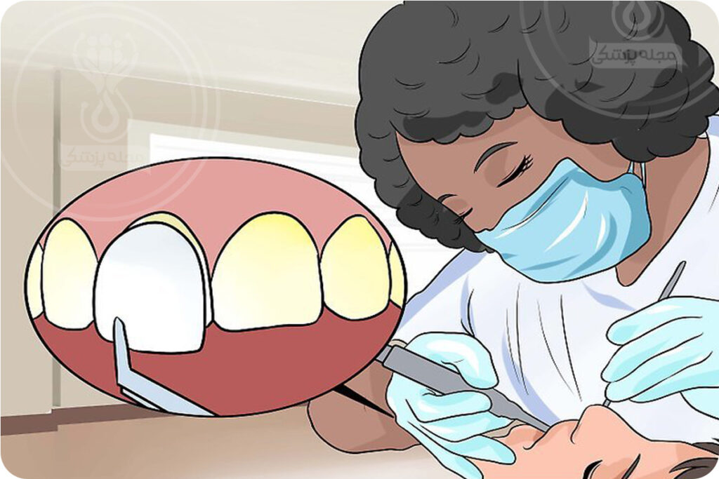 باندینگ یا کامپوزیت دندان برای رفع حسایت دندان به سردی و گرمی