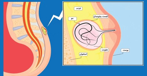 آیا کیست مویی دوباره عود میکند؟