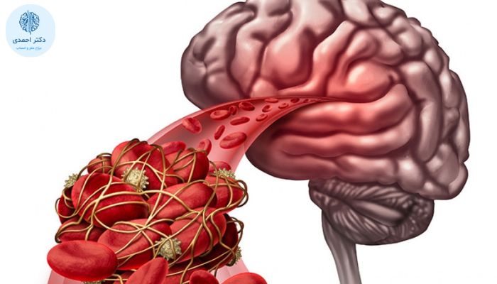 آیا همه افراد بعد از سکته مغزی قدرت تکلمشان را از دست می دهند؟