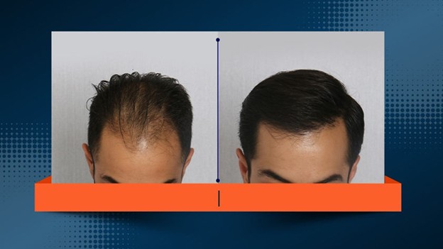 بدون کچل‌کردن و تراشیدن سر کاشت کنید