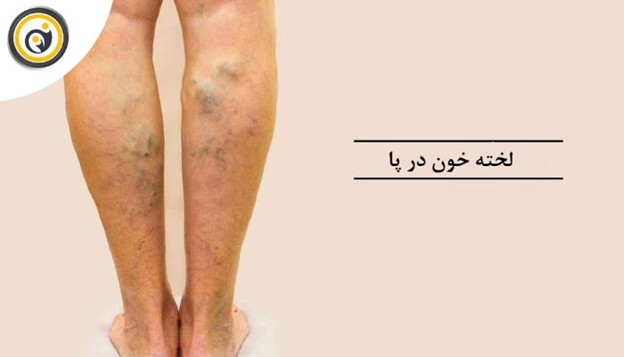 آیا ممکن است تورم پاهایم به دلیل اختلال در گردش خون باشد؟