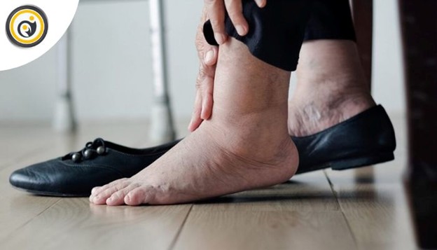 آیا ممکن است تورم پاهایم به دلیل اختلال در گردش خون باشد؟