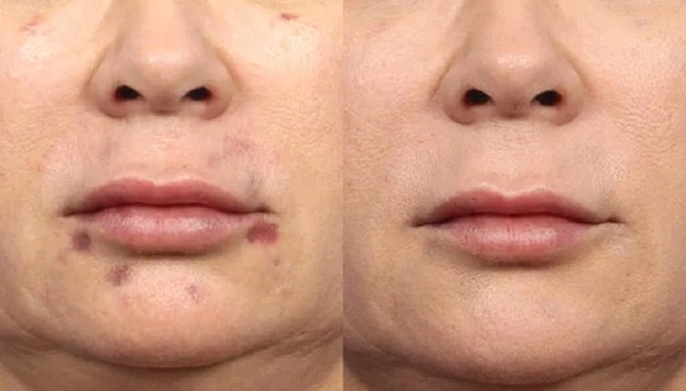 آیا بعد از تزریق ژل صورت کبود می شود؟