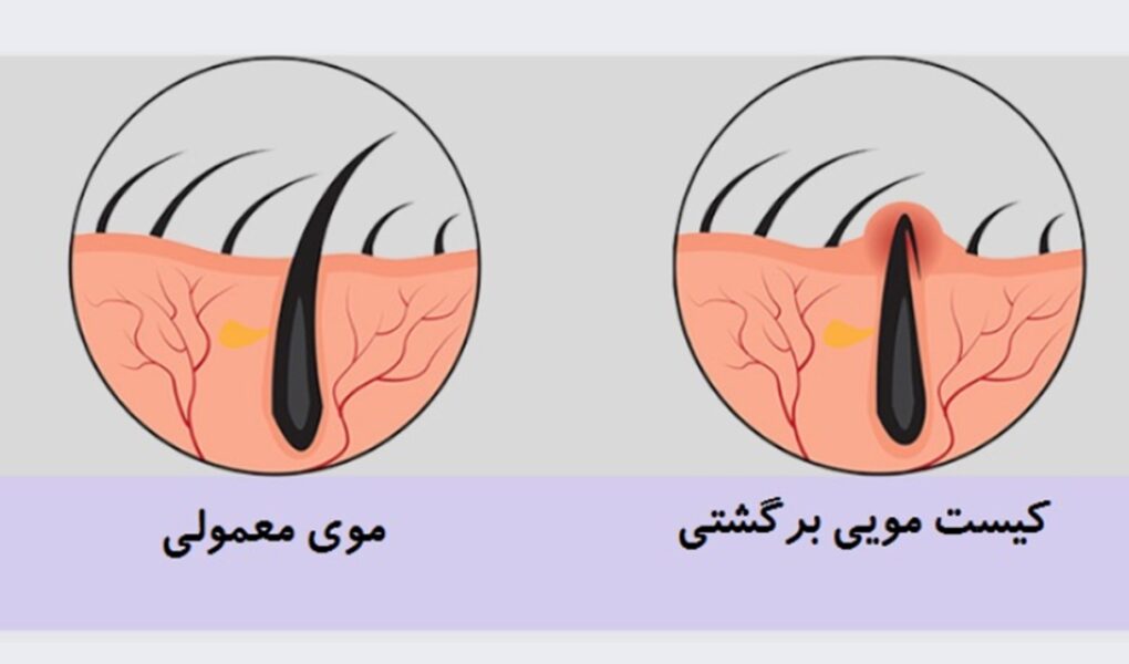 آیا کیست مویی دوباره عود میکند؟