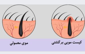 آیا کیست مویی دوباره عود میکند؟