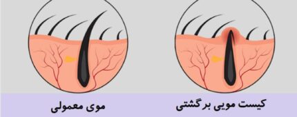 آیا کیست مویی دوباره عود میکند؟