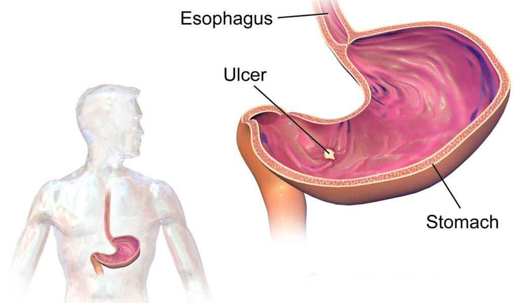 راهنمای جامع زخم معده: علل، علائم، تشخیص و گزینه‌های درمانی