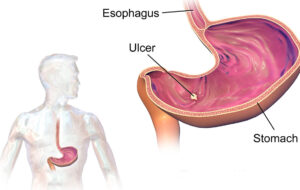 راهنمای جامع زخم معده: علل، علائم، تشخیص و گزینه‌های درمانی