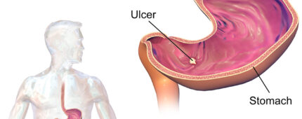 راهنمای جامع زخم معده: علل، علائم، تشخیص و گزینه‌های درمانی