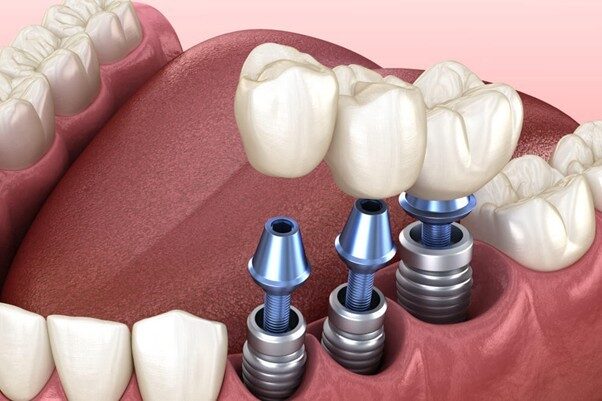 آیا سرطان از عوارض جانبی کاشت ایمپلنت است؟