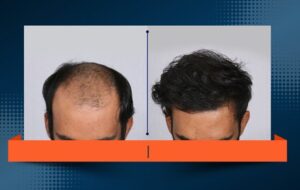 بدون کچلکردن و تراشیدن سر کاشت کنید