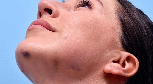 آیا بعد از تزریق ژل صورت کبود می شود؟