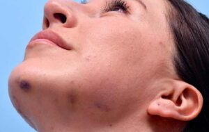 آیا بعد از تزریق ژل صورت کبود می شود؟