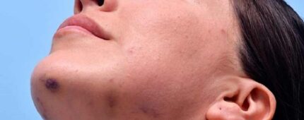 آیا بعد از تزریق ژل صورت کبود می شود؟