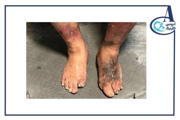 چرا مراجعه به کلینیک تخصصی پای دیابتی از قطع عضو جلوگیری میکند؟