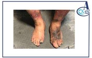 چرا مراجعه به کلینیک تخصصی پای دیابتی از قطع عضو جلوگیری میکند؟