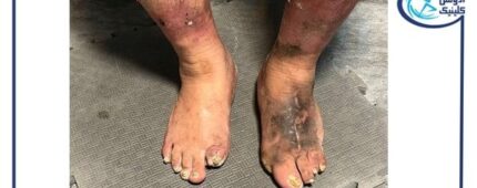 چرا مراجعه به کلینیک تخصصی پای دیابتی از قطع عضو جلوگیری میکند؟