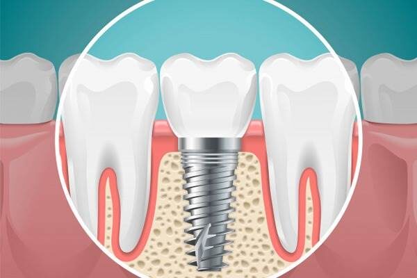 ایمپلنت دندان و بایدها و نبایدهای آن