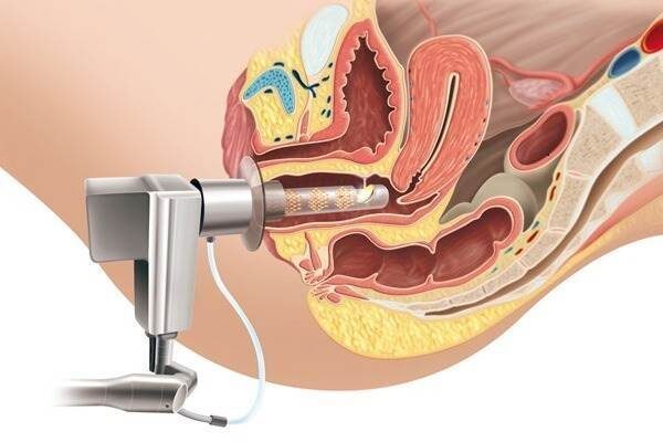 همه چیز در مورد لیزر واژن