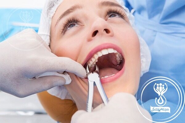 کشیدن دندان و باید و نبایدهای آن