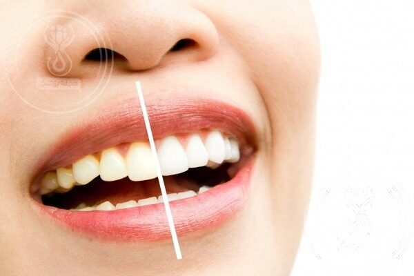 جرمگیری طبیعی دندان