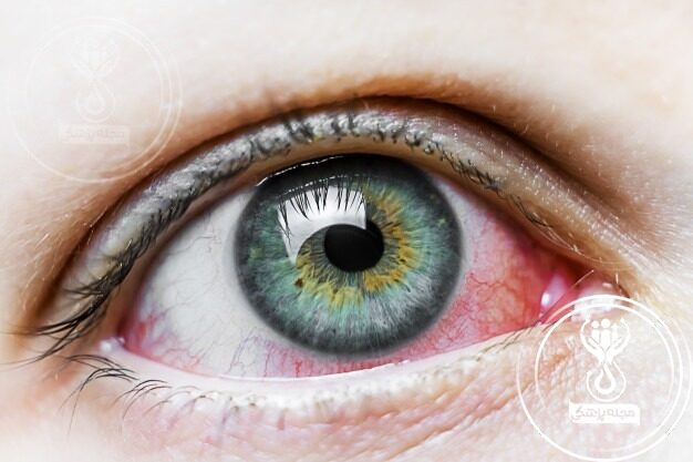 داروهایی با عوارض چشمی