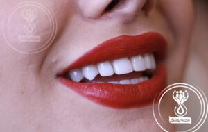 کامپوزیت دندان، برای ساختن لبخندی زیبا + مزایا و معایب آن از زبان متخصصان