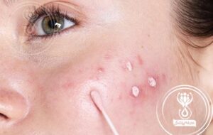۱۰ درمان جوش صورت با بهترین و موثرترین روش های خانگی + راهکارهای تخصصی