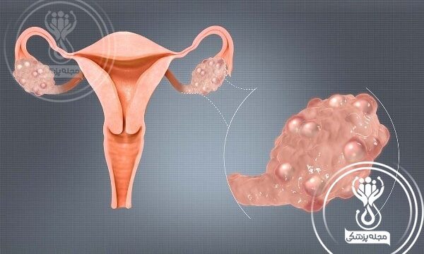 تنبلی تخمدان و پریود نشدن+ تنبلی تخمدان و حامله نشدن+‌ درمان تنبلی تخمدان در خانم‌های متاهل و مجرد